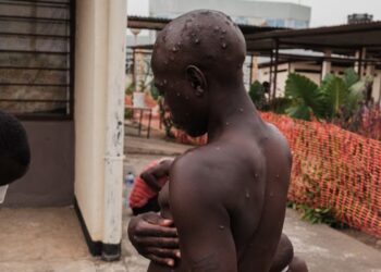 Le paix du gérance burundais sur l&rsquo;corruption de mpox suffoqué