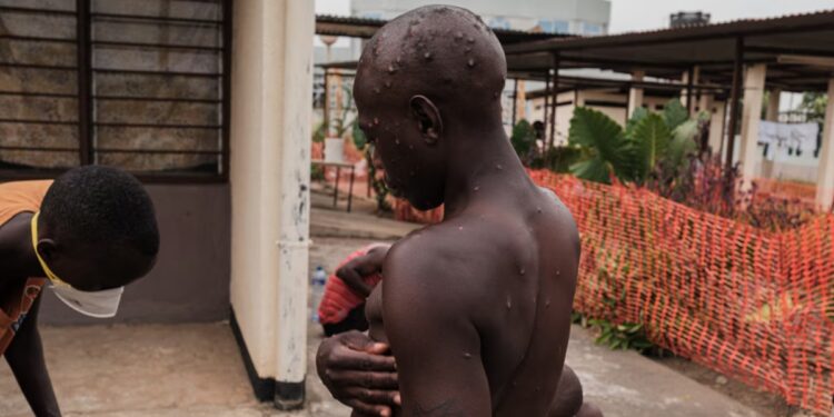 Le paix du gérance burundais sur l&rsquo;corruption de mpox suffoqué