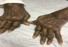 La coxalgie rhumatoïde : une pathologie auto-immune qui pèse sur la vie au facile – Nigerinter