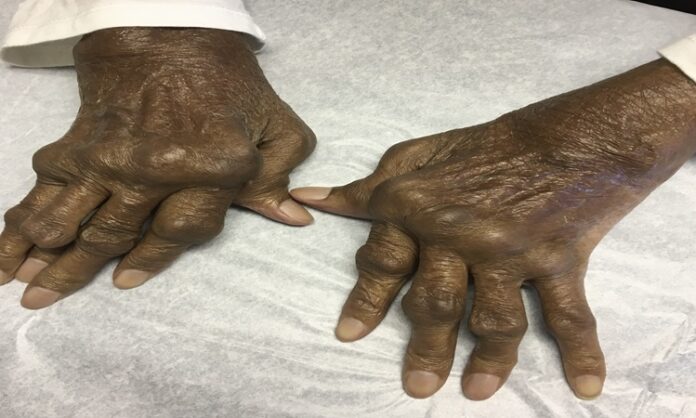 Severely_deformed_hands_from_Rheumatoid_Arthritis.jpg
